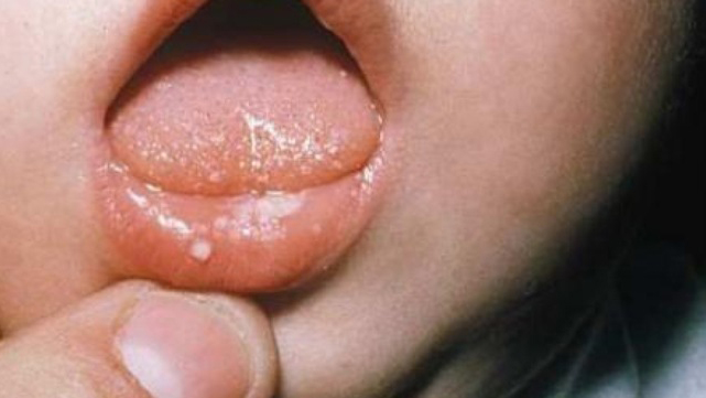 Hướng dẫn cách phòng và điều trị bệnh ở miệng của trẻ